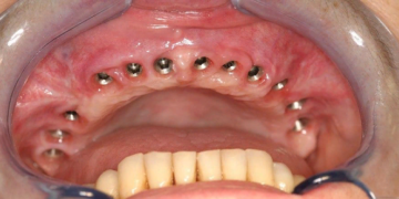 Правила и способы имплантации верхней челюсти