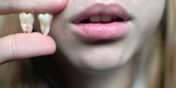 Показания к удалению зубов мудрости и рекомендации