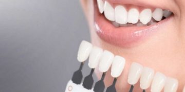 Как осуществляется отбеливание зубов: основные правила проведения процедуры