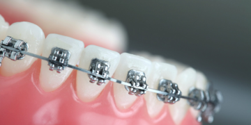Выравнивание зубов при помощи брекет-систем: достоинства и виды