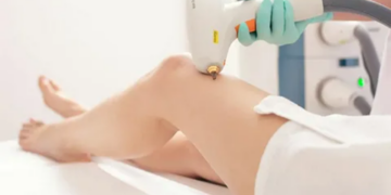 Лазерна терапія варикозних вен: переваги методу і швидке відновлення