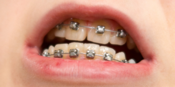 З якого віку можна ставити брекети дитині