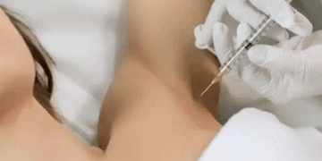 Лечение гипергидроза в ML Beauty Clinic: что нужно знать