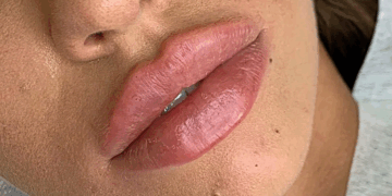 Современные способы и технология увеличения губ