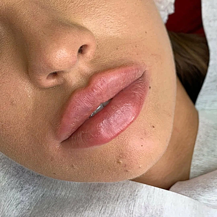 Современные способы и технология увеличения губ