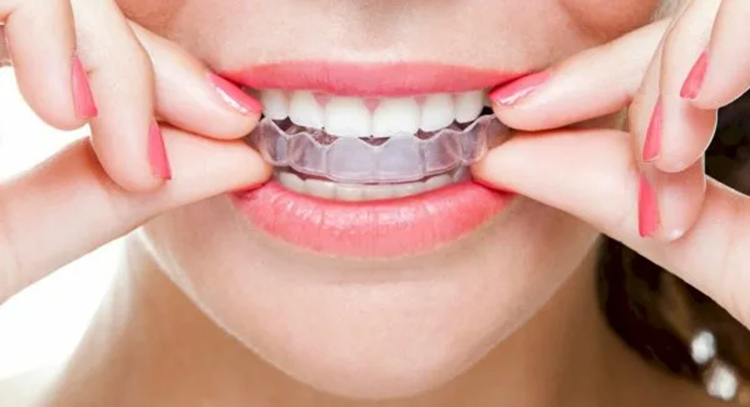 Выравнивание зубов: что нужно знать, особенности и правила