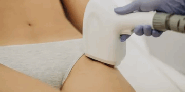 Основи та рекомендації щодо правильного проведення лазерної епіляції для безпечного результату