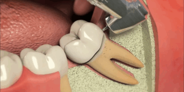 Как правильно подойти к процедуре удаления зуба мудрости