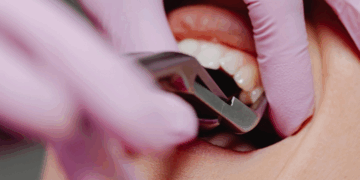 Удаление зуба мудрости: особенности и нюансы